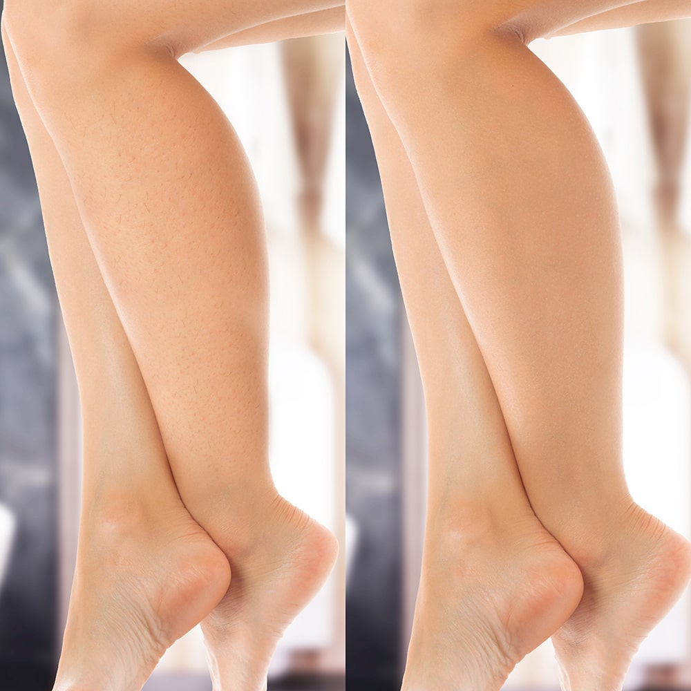 Lumi IPL Hair Remover