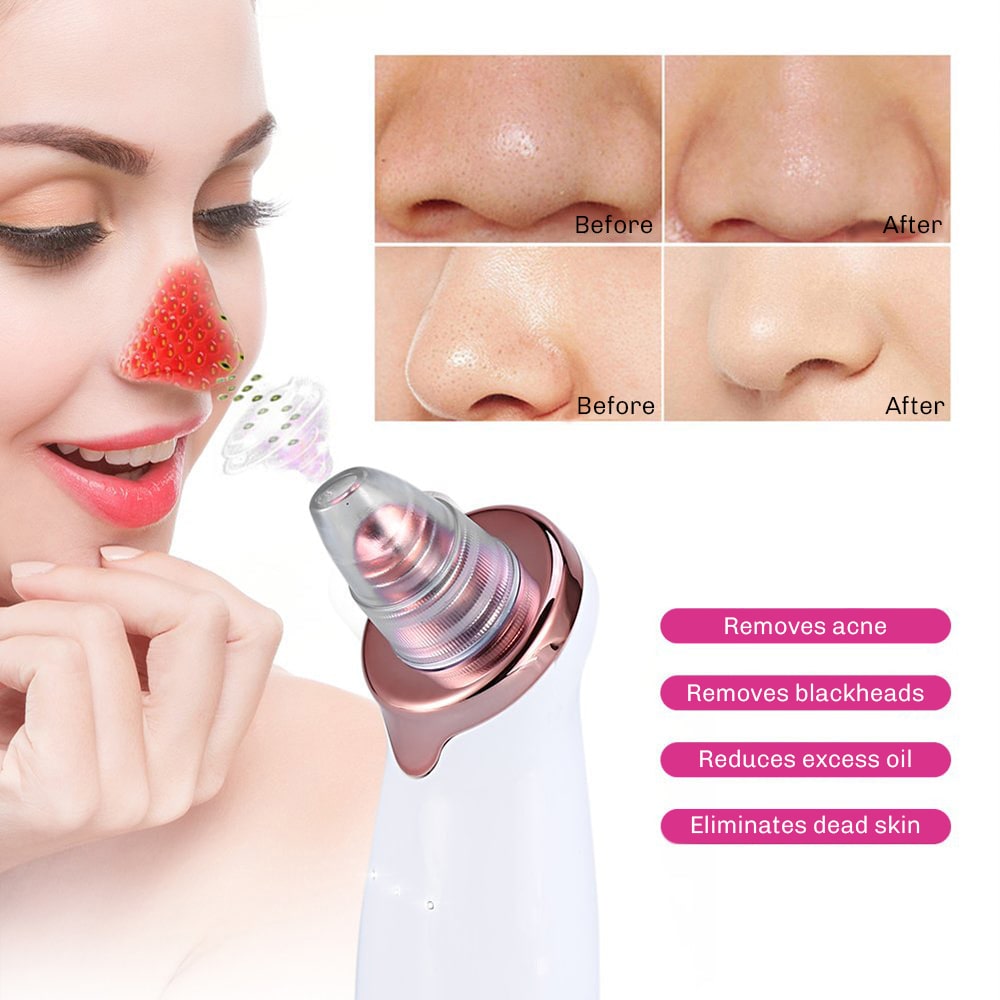 SkinClear 3 Blackhead Remover