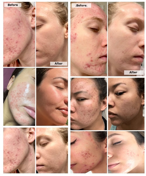 LumiGlow LED Face Mask