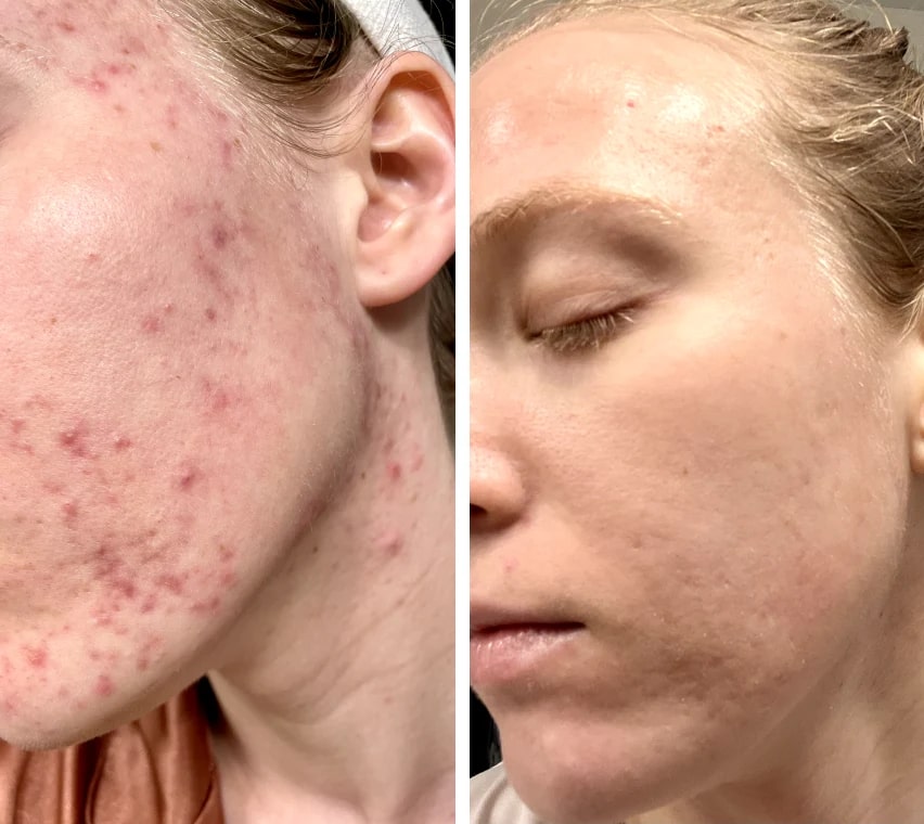 LumiDark LED Face Mask