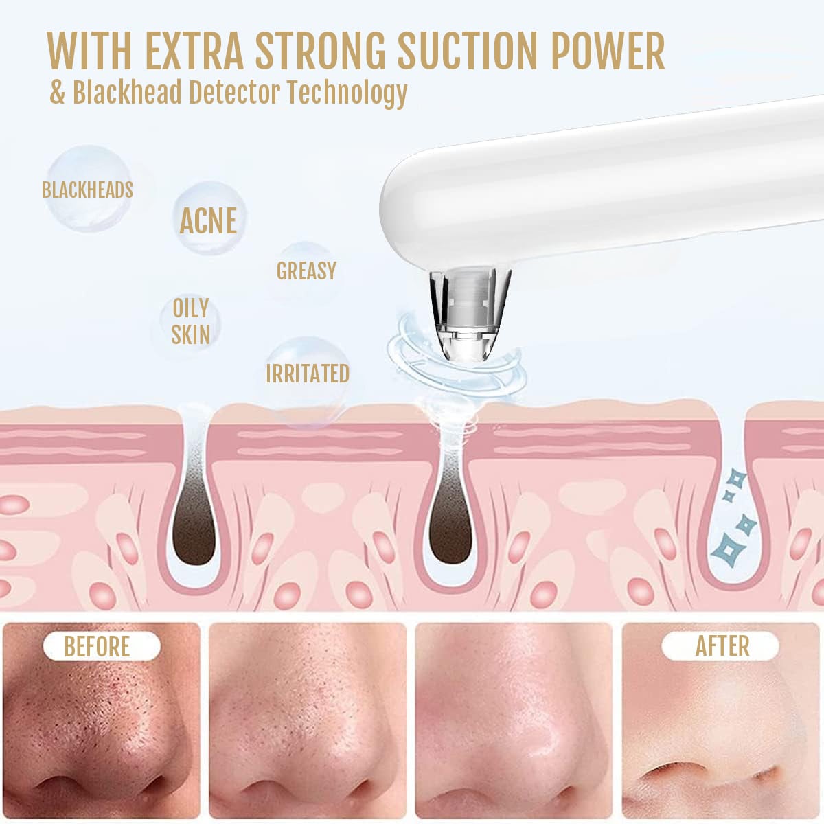 Blackhead Removal Kit