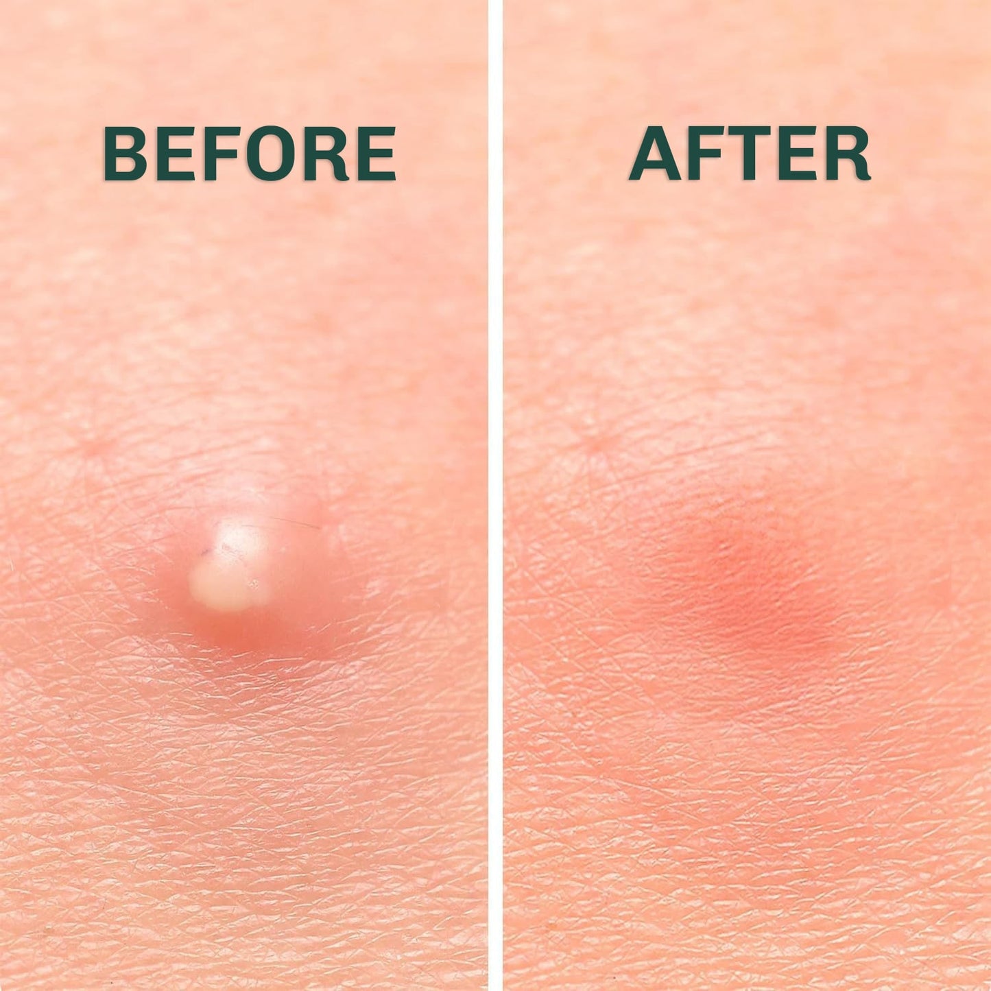 SuperClear Pimple Patches