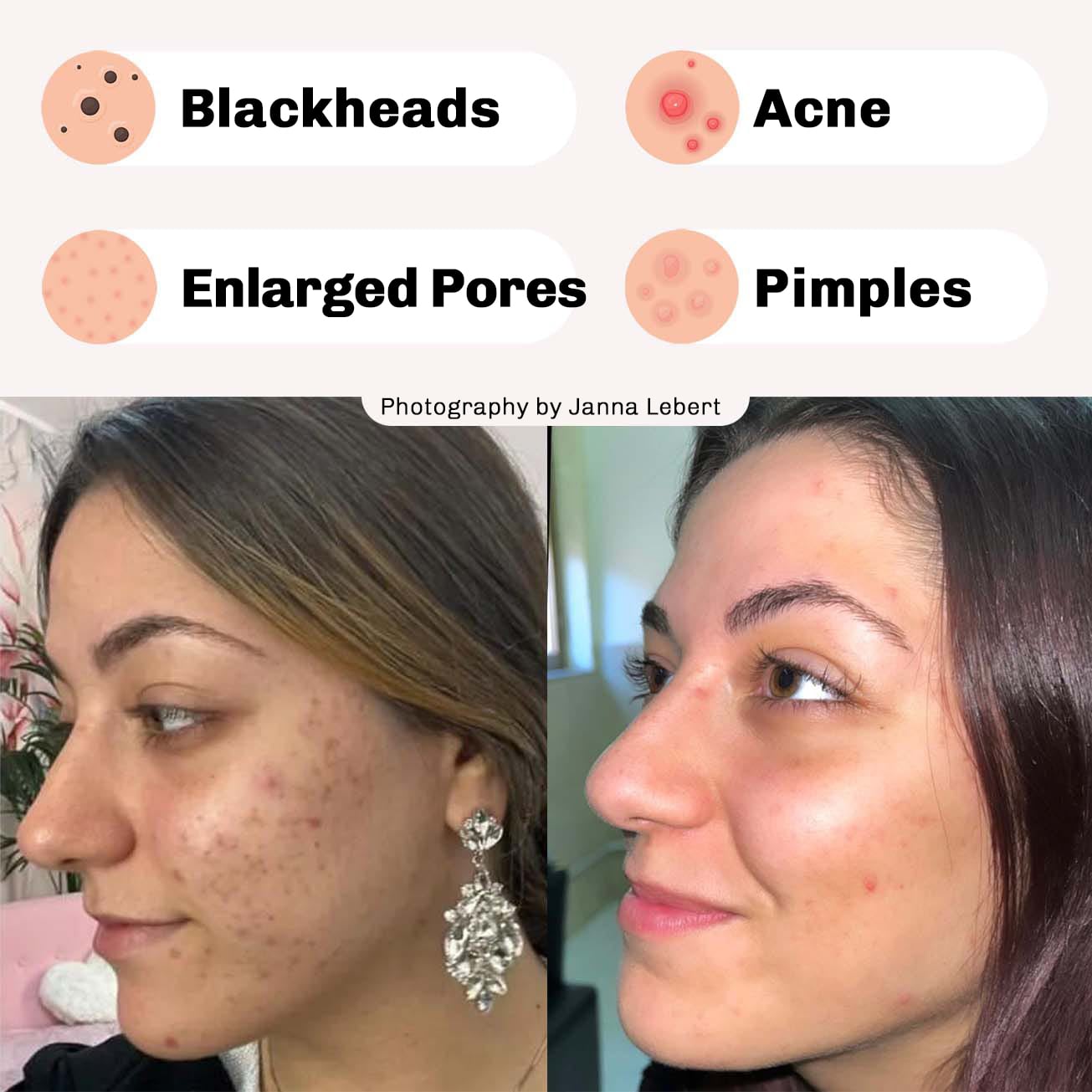 Blackhead Remover Cream