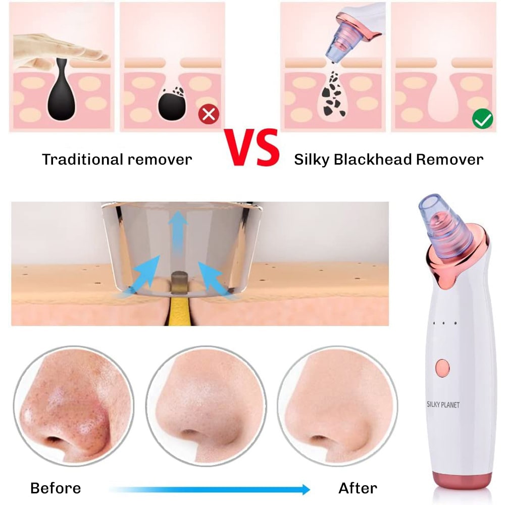 SkinClear 3 Blackhead Remover